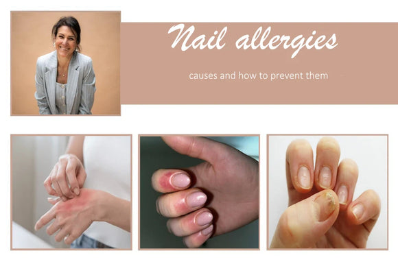 Nail allergy: causes and how to prevent it